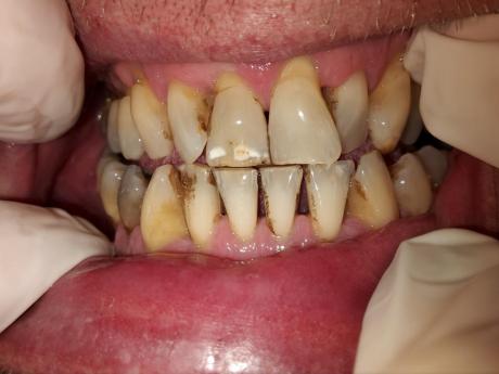 Pískování zubů - air- flow