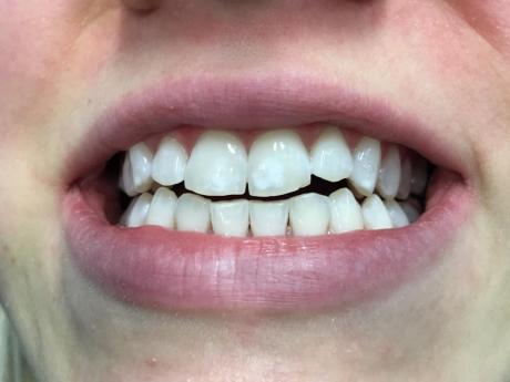 Bělení zubů