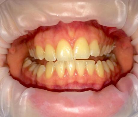 Bělení zubů