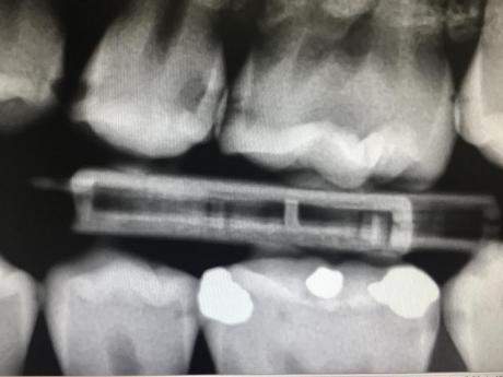 Zubní kazy v aproximálních prostorech - dívka, 15 let