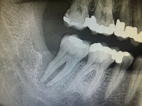 Náhodně objevená periodontitida zubu 47
