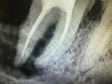 Zub po endodontickém ošetření kořenových kanálků (2012)