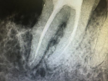 Zub 47 s hojicím se defektem kosti