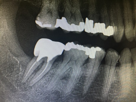 Plně funkční zub 47 , vyhojený defekt kosti a postendodontické ošetření