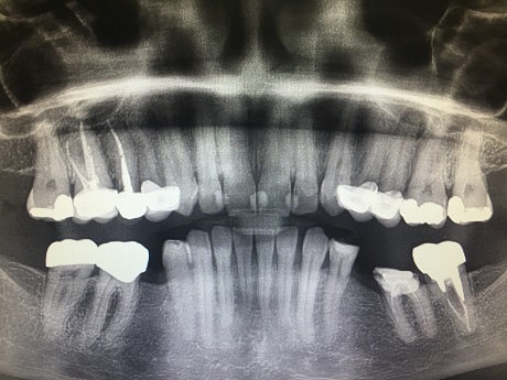 OPG snímek a zub vhodný pro reendodoncii