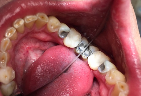 Postendodontická dostavba s výztuhou sklovláknovými FRC čepy - zub 36, dolní čelist