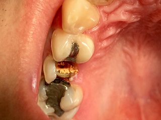 Dostavba devitalizovaného zubu 15 FRC čepem před preparací na korunku 