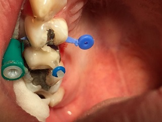 Dostavba devitalizovaného zubu 15 FRC čepem před preparací na korunku 
