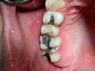Dostavba devitalizovaného zubu 15 FRC čepem před preparací na korunku 