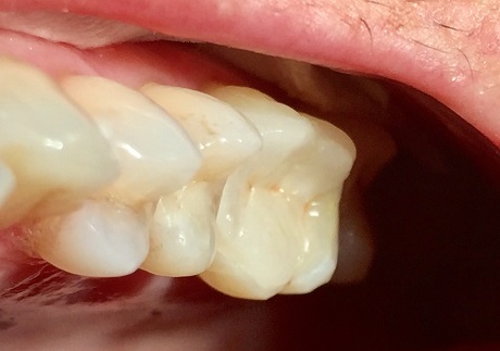 Keramická onlay na zubu 26