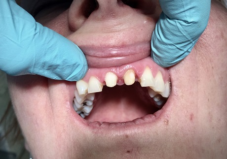 Dostavba zubu 11 pomocí FRC sklolaminátového čepu
