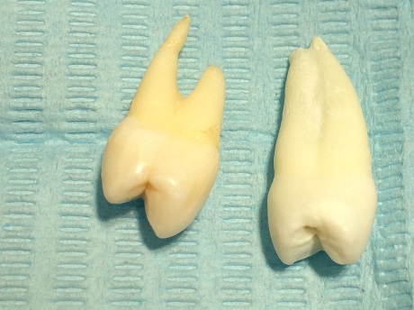 Stálé zuby extrahované z ortodontickych důvodů