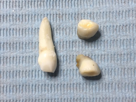 Dětské ( mléčné, dočasné ) zuby s rezorbcí kořenů a bez ní